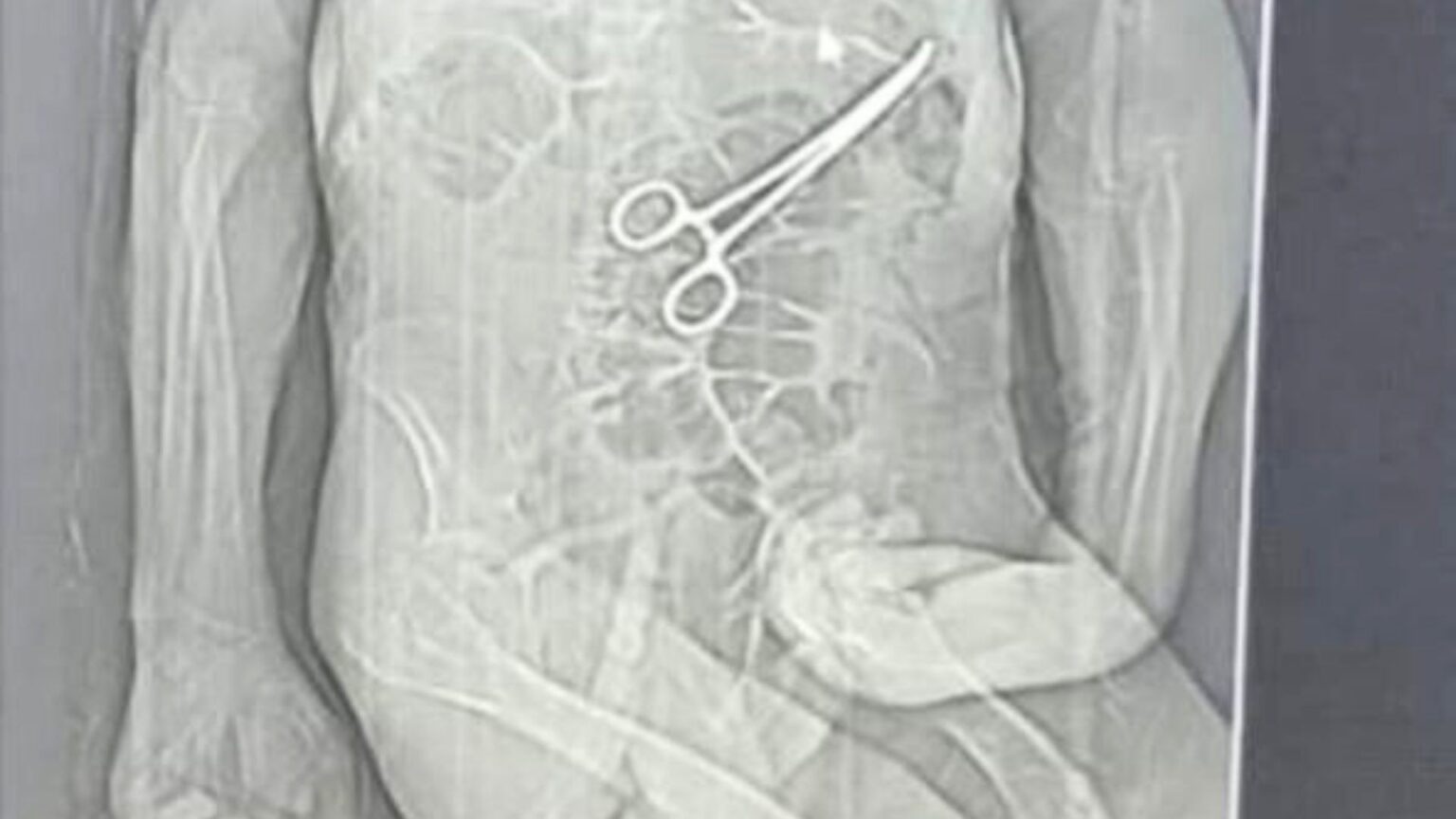 Idoso Morre na Véspera do Natal após Cirurgia em MG: Família Denuncia Corpo Estranho Esquecido