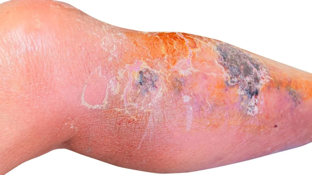 Como Tratar a Celulite Infecciosa e Prevenir a Sepse de Forma Eficaz Como Tratar a Celulite Infecciosa e Prevenir a Sepse de Forma Eficaz