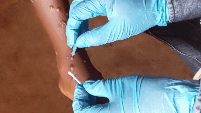 Minas Gerais Registra 2 Novos Casos de Mpox e Total Chega a 17 Minas Gerais Registra 2 Novos Casos de Mpox e Total Chega a 17