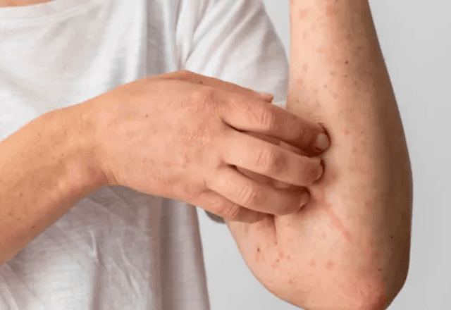 Minas Gerais Registra Mais 2 Casos de Mpox e Total Chega a 17 Minas Gerais Registra Mais 2 Casos de Mpox e Total Chega a 17